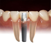 Implantes dentários, Aparelhos Ortodonticos/ DR. Ramon Mesqu
